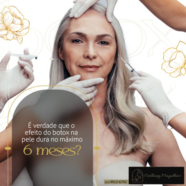 É verdade que o efeito do botox na pele dura no máximo 6 meses?