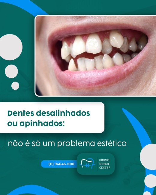 Dentes desalinhados ou apinhados: não é só um problema estético