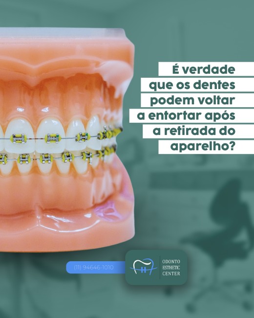 É verdade que os dentes podem voltar a entortar após a retirada do aparelho?