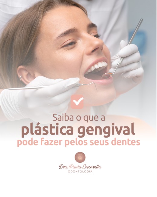Saiba o que a plástica gengival pode fazer pelos seus dentes