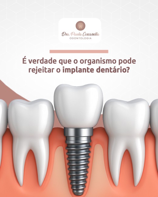 É verdade que o organismo pode rejeitar o implante dentário?