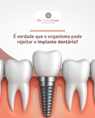 É verdade que o organismo pode rejeitar o implante dentário?