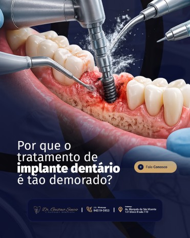 Por que o tratamento de implante dentário é tão demorado?