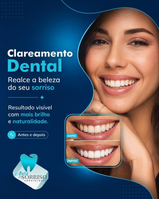 Clareamento Dental